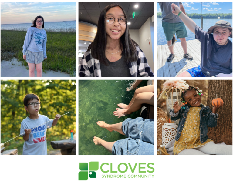 Cloves Syndrome Community Cloves Syndrome Community